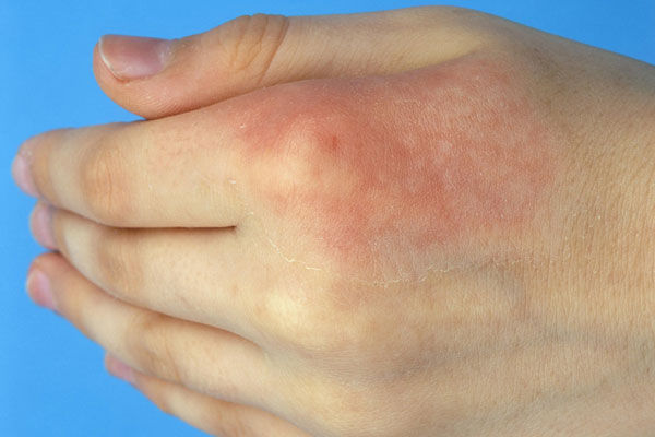 謠言第92期:燙傷后抹牙膏不留疤?