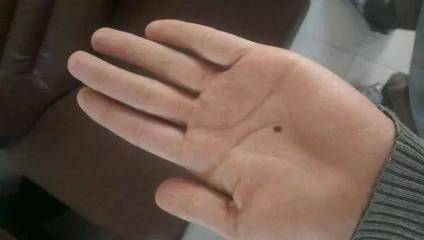 有“痣”者，須注意！磨擦可能帶來的健康風險